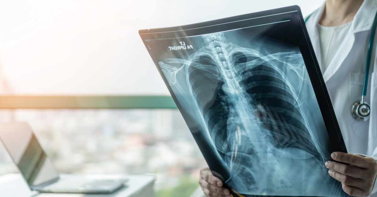 Image of a doctor holding and xray of a human chest